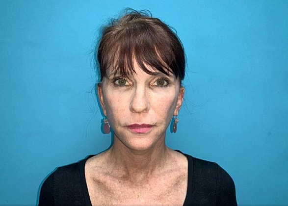 Facelift Before & After