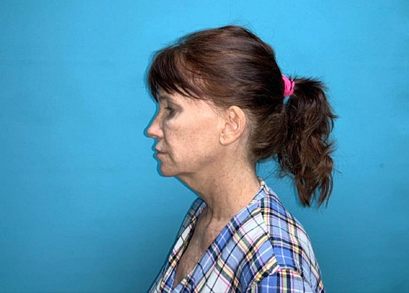 Facelift Before & After