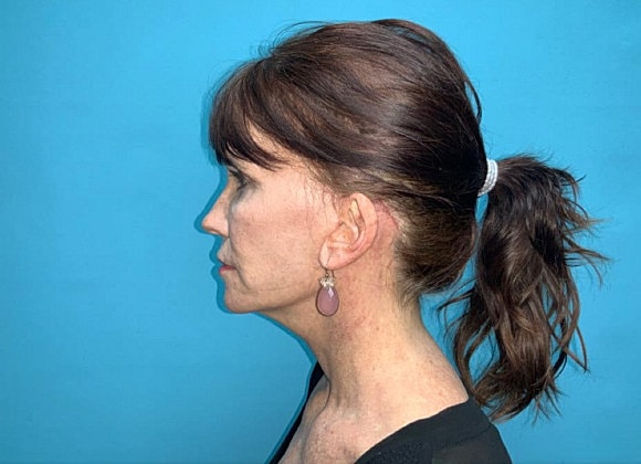 Facelift Before & After