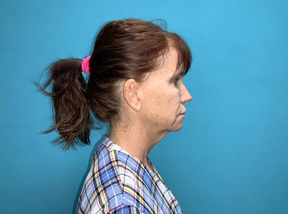 Facelift Before & After