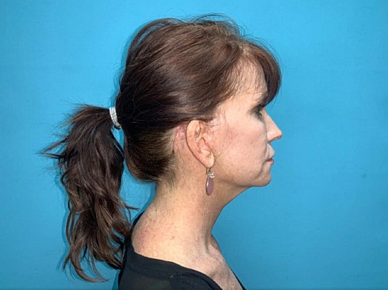 Facelift Before & After