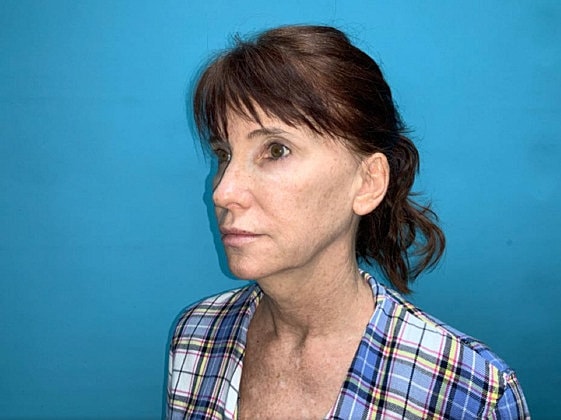 Facelift Before & After