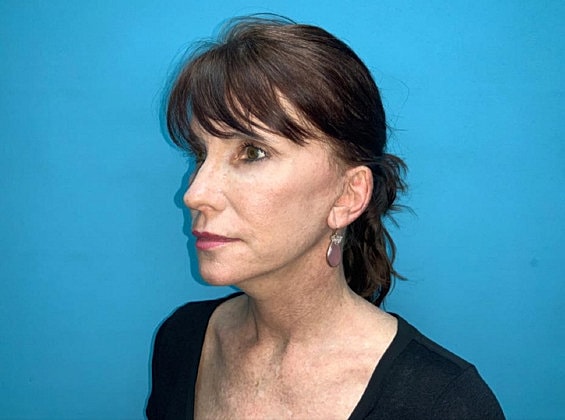 Facelift Before & After