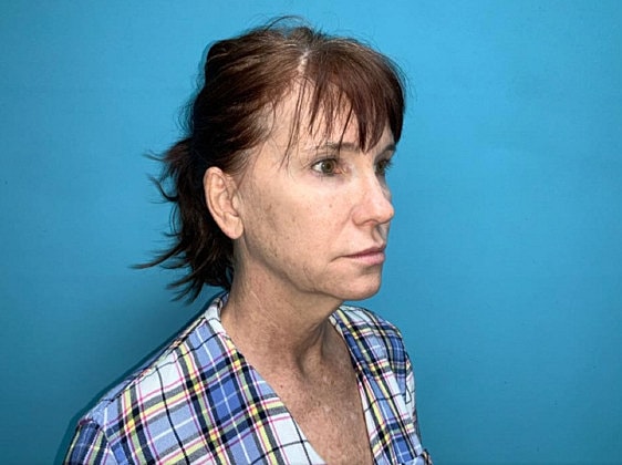 Facelift Before & After
