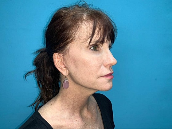 Facelift Before & After