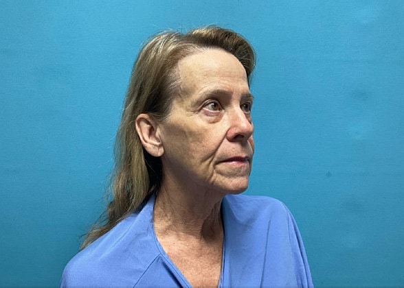 Facelift Before & After