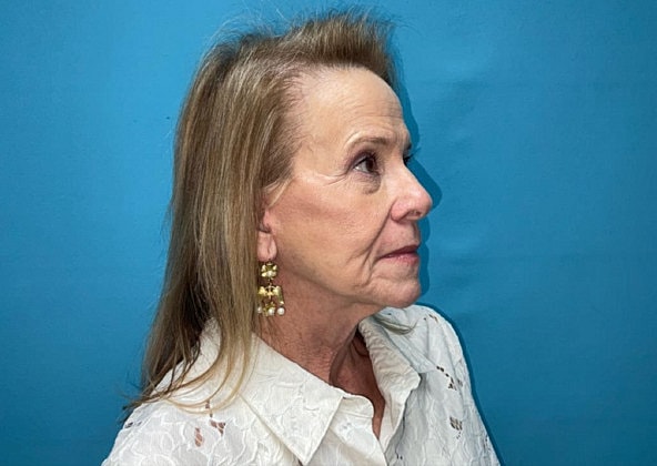 Facelift Before & After