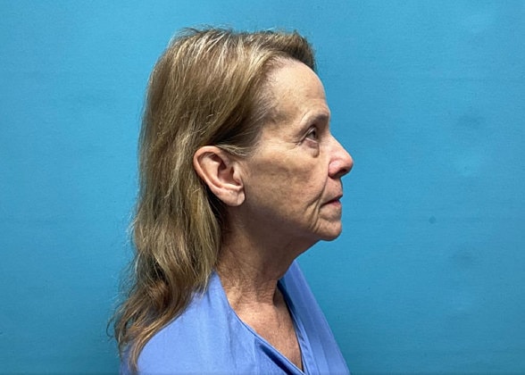 Facelift Before & After