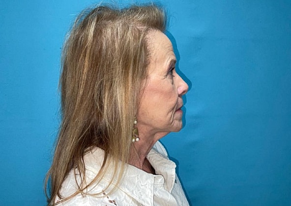 Facelift Before & After