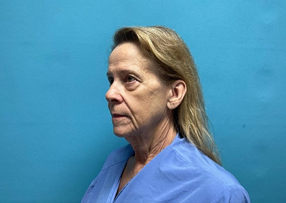 Facelift Before & After