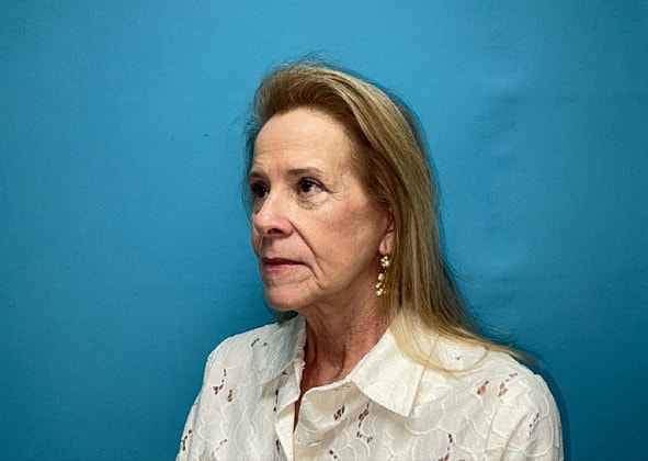 Facelift Before & After