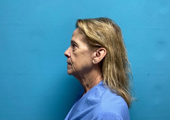 Facelift Before & After