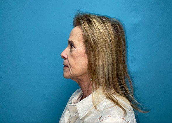Facelift Before & After