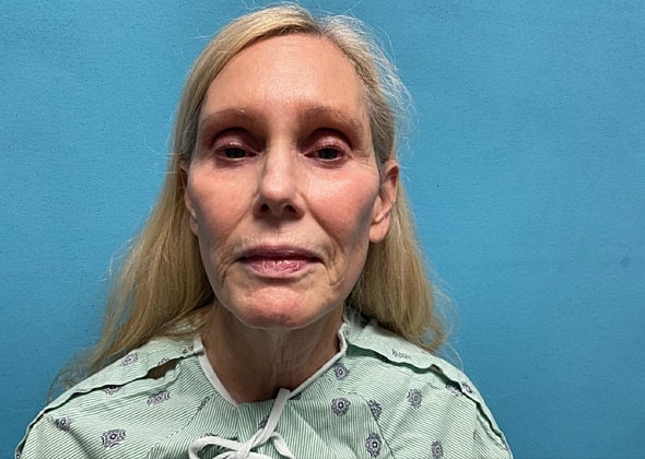 Facelift Before & After