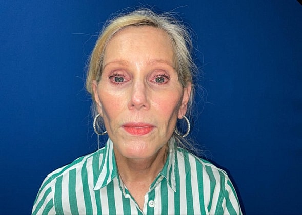 Facelift Before & After