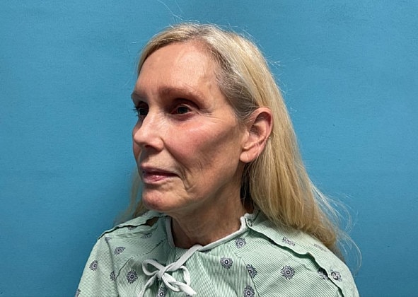 Facelift Before & After
