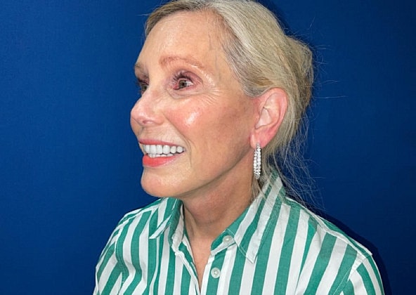 Facelift Before & After