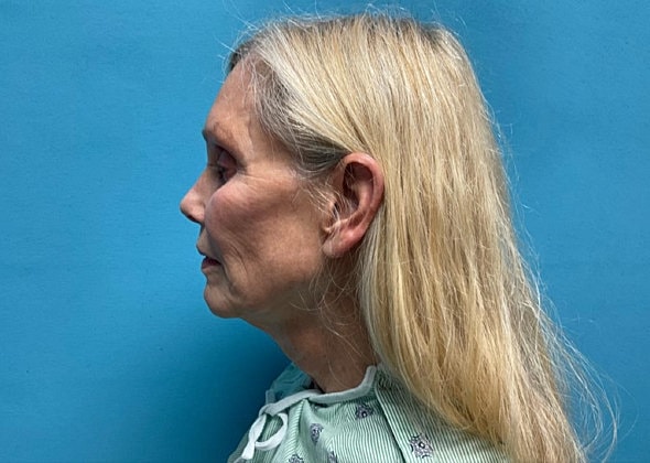 Facelift Before & After