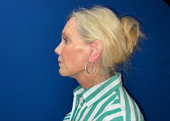 Facelift Before & After