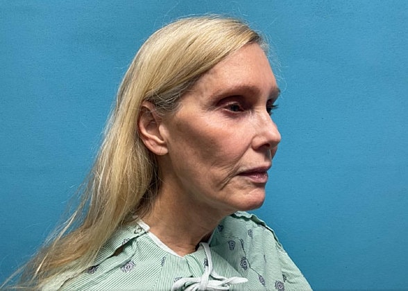 Facelift Before & After