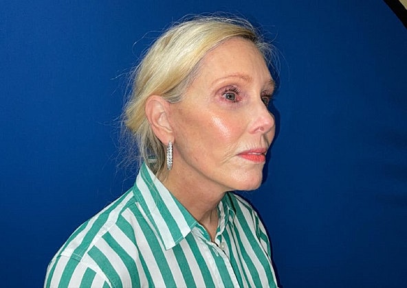 Facelift Before & After