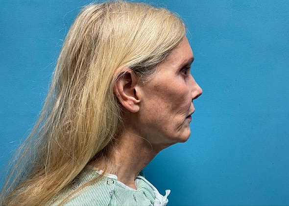Facelift Before & After