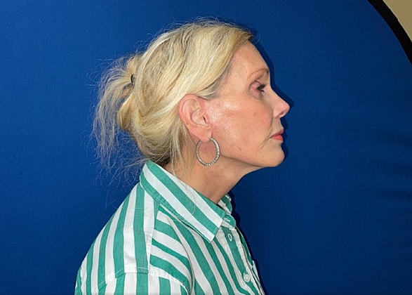 Facelift Before & After
