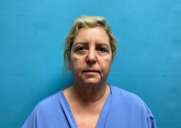 Facelift Before & After