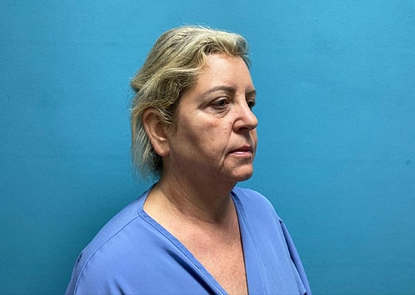 Facelift Before & After