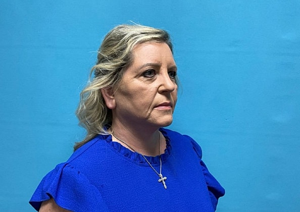 Facelift Before & After