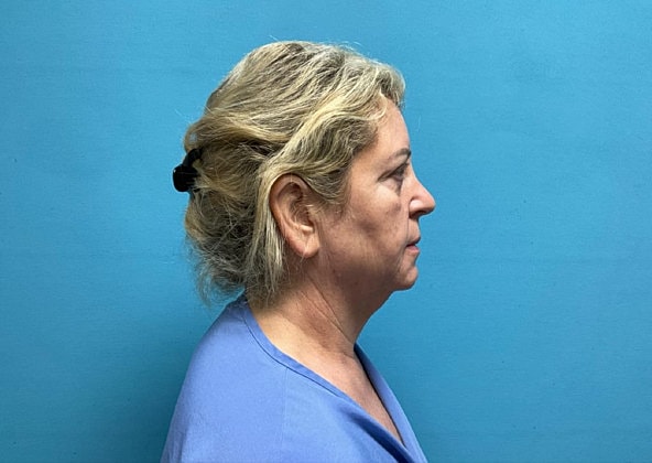 Facelift Before & After
