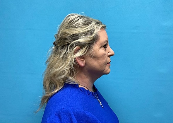 Facelift Before & After
