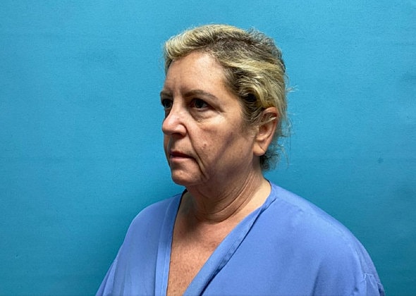 Facelift Before & After