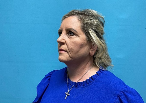 Facelift Before & After