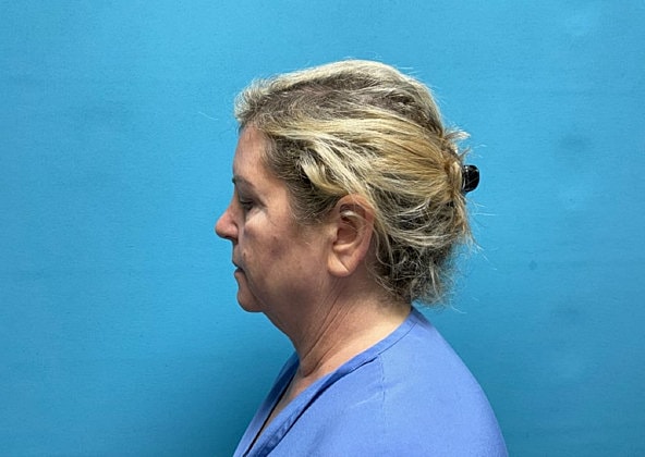 Facelift Before & After