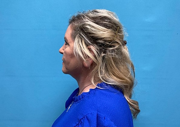 Facelift Before & After
