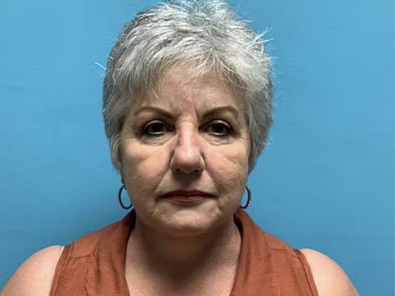 Facelift Before & After
