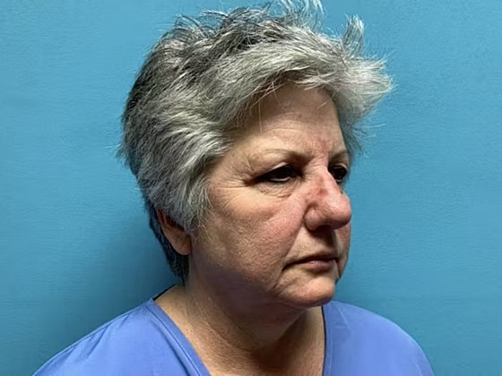 Facelift Before & After