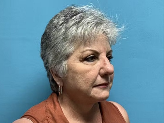Facelift Before & After