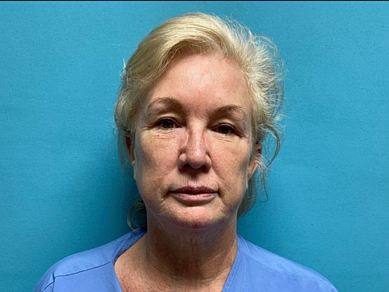 Facelift Before & After