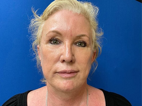 Facelift Before & After