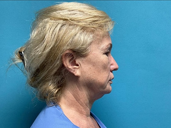 Facelift Before & After