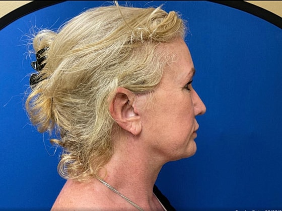 Facelift Before & After