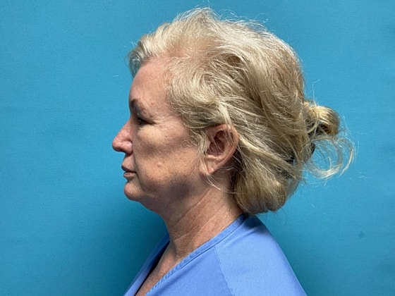 Facelift Before & After