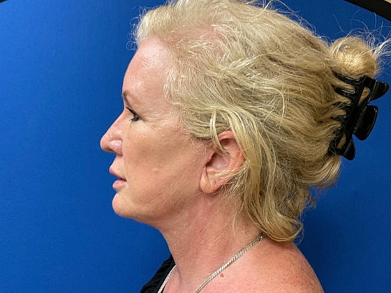 Facelift Before & After