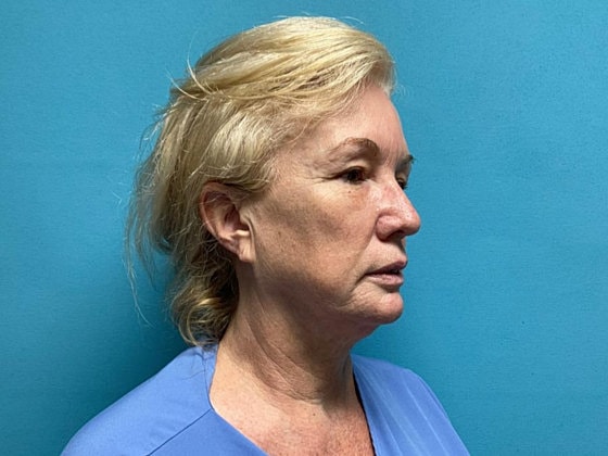 Facelift Before & After