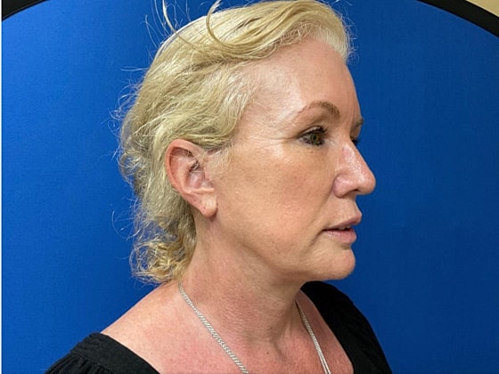 Facelift Before & After