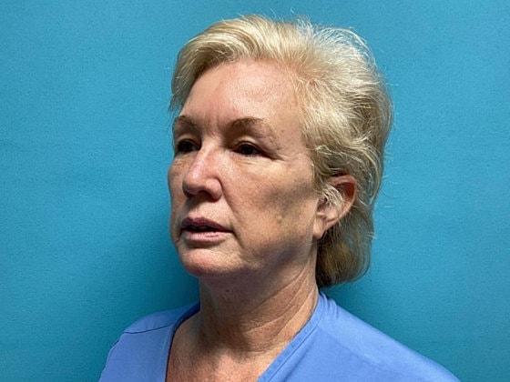 Facelift Before & After