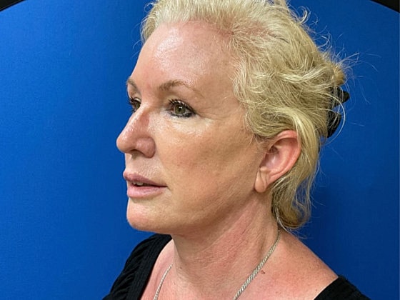 Facelift Before & After