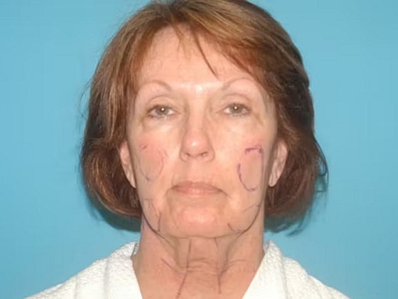 Facelift Before & After